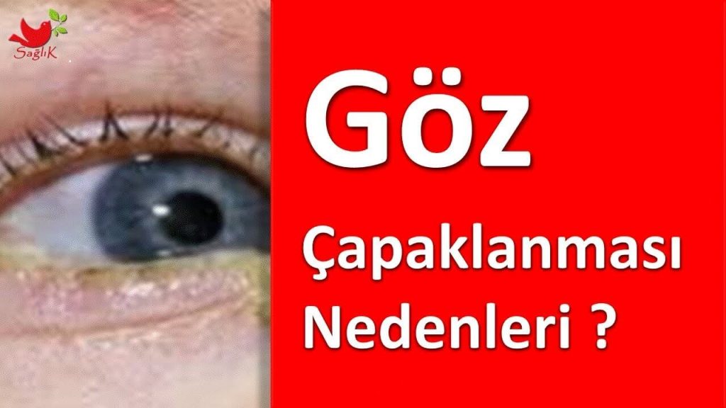 Gözde Çapak Oluşması Neden Olur? Özel Esencan Hastanesi